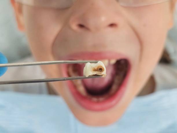 Best Broken or Cracked Tooth Emergency Dentist in Fort Madison, IA